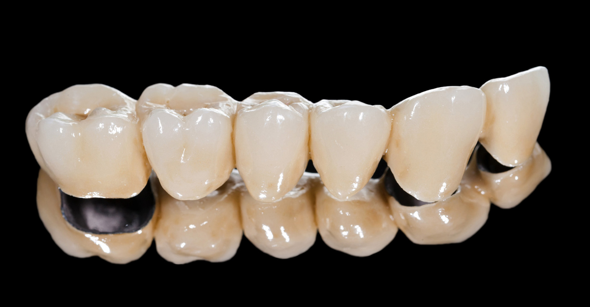 Металлокерамические коронки на зубы