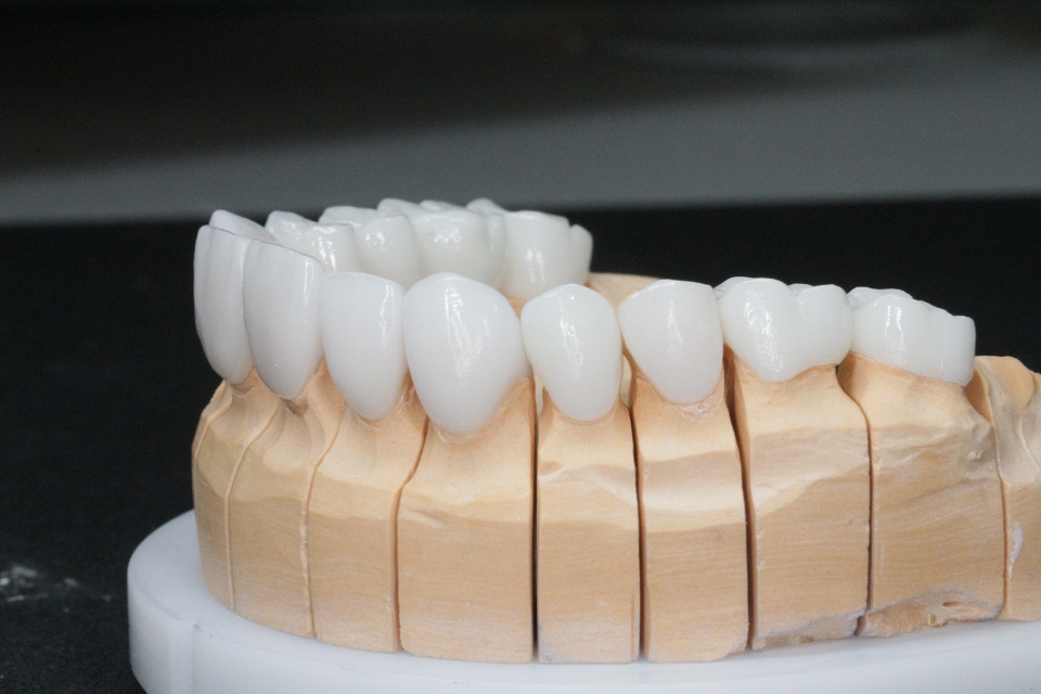 Металлопластиковые коронки за зубы