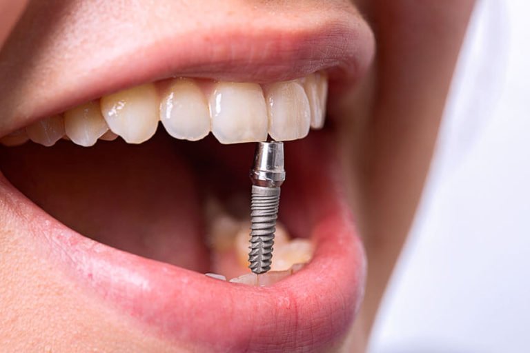 Как проводится лучшая имплантация зубов?