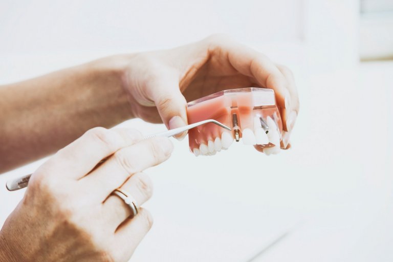 Имплантация зубов отзывы