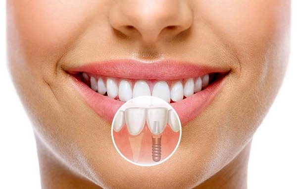 Установка зубного импланта: этапы и сроки, технологии и цены