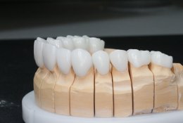 Зубные коронки: обзор и преимущества