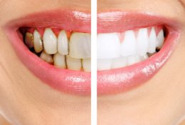 Основные причины почему чернеют зубы