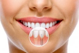 Установка зубного импланта: этапы и сроки, технологии и цены