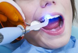 Лечение зубов пломбированием